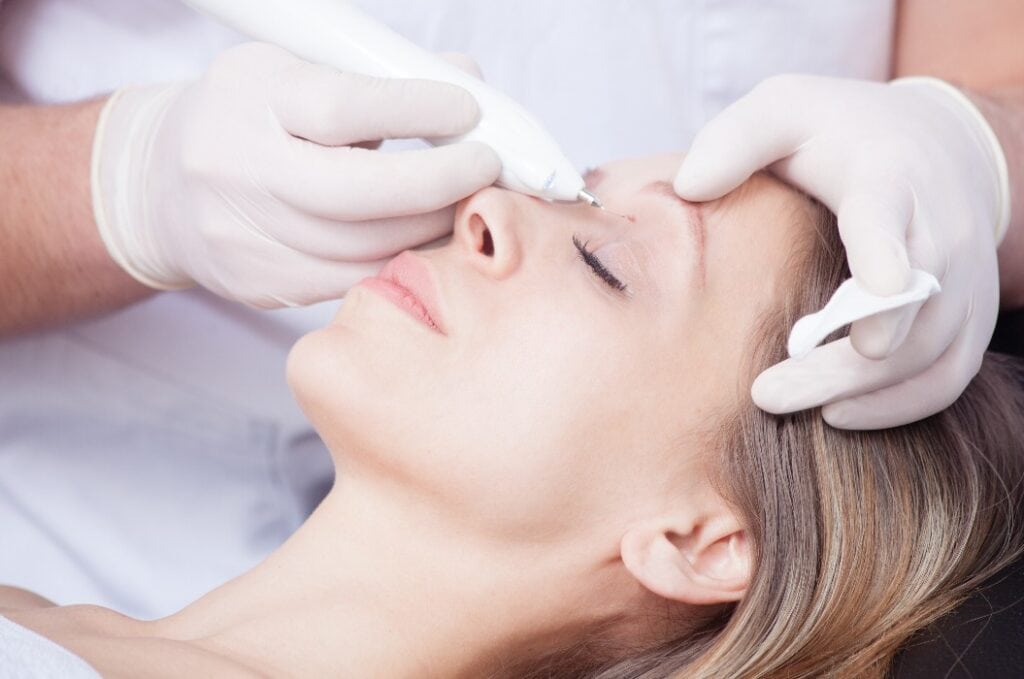 woman during wart removal above the eye